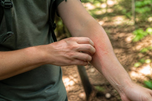 How to Stop Bug Bites Itching: Fast Relief Guide