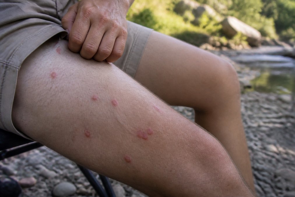Natural Remedies for Deer Fly Bites That Work